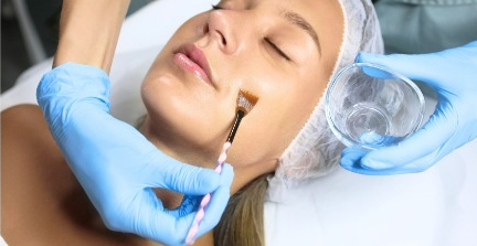 Chemical Peels